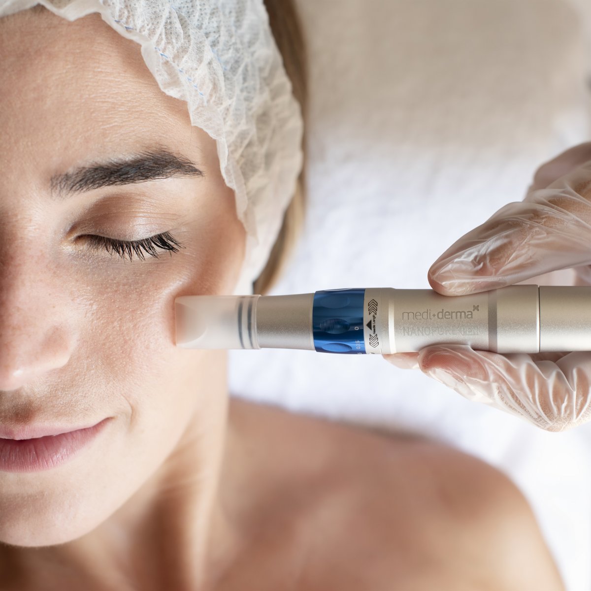 Tratamiento con Micropunción